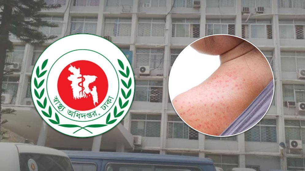হাম উপসর্গে আরো ৫ শিশুর মৃত্যু