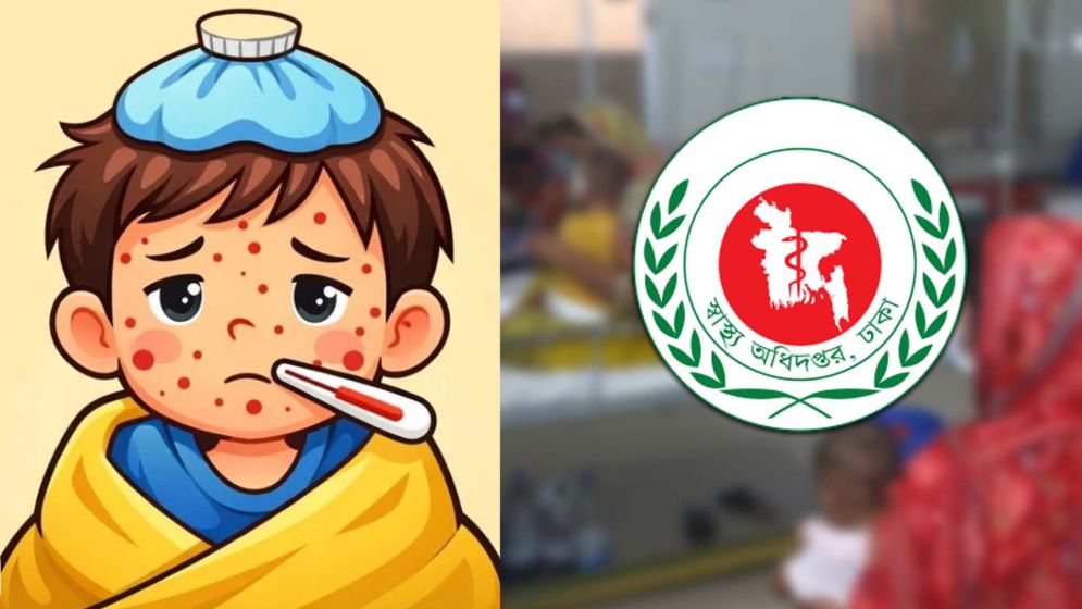 হাম উপসর্গে ৮ জনের মৃত্যু, নতুন রোগী ১০৬৫